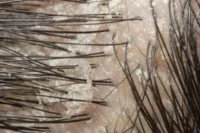 Anti-Dandruff Shampoo